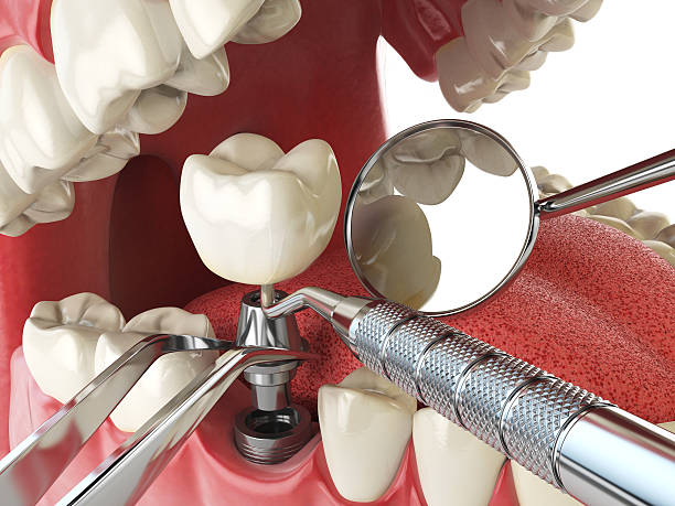 Best Emergency Wisdom Teeth Removal in Willowbrook, CA